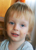 Two Year Old Dima has cholesteatoma, microtia and atresia of the right ear canal. Requires surgical treatment.